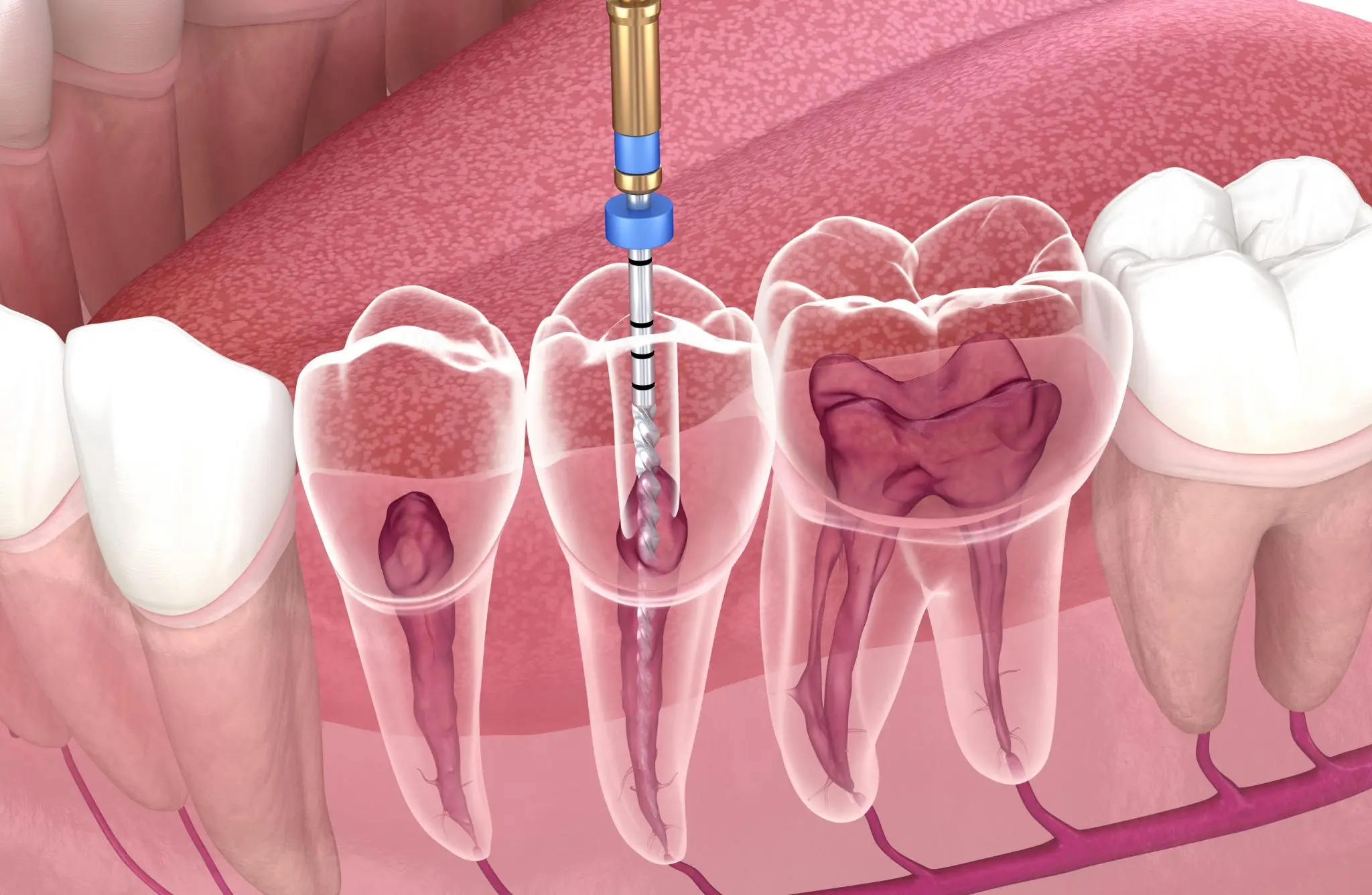 Tratamiento de endodoncia en DiBian Odontología en Belgrano, CABA